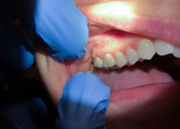 Best Knocked-Out Tooth (Avulsed Tooth) Treatment in Albion, MI